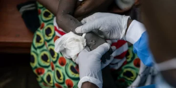 OMS: Casos de mpox na República Democrática do Congo estão a estabilizar