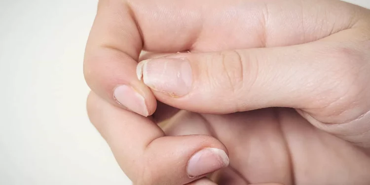 Colesterol perigosamente elevado? O sintoma pouco conhecido nas unhas