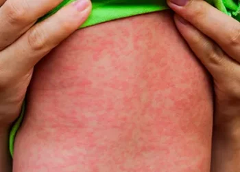 EUA registram aumento alarmante de casos de Sarampo