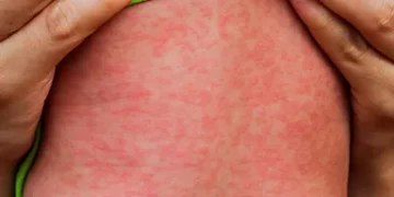 EUA registram aumento alarmante de casos de Sarampo