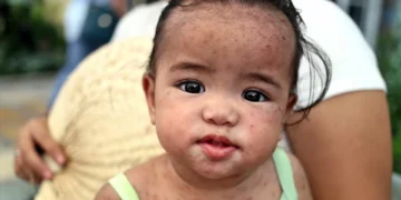 Mortes por sarampo caíram 88% desde 2000, mas aumenta número de casos