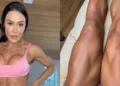 Gracyanne Barbosa mostra cicatrizes de cirurgia: “Marcas de vitória”