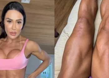 Gracyanne Barbosa mostra cicatrizes de cirurgia: “Marcas de vitória”