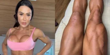 Gracyanne Barbosa mostra cicatrizes de cirurgia: “Marcas de vitória”