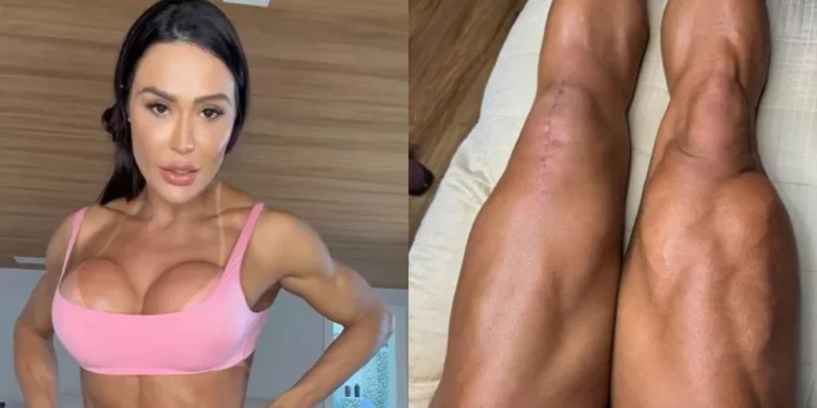 Gracyanne Barbosa mostra cicatrizes de cirurgia: “Marcas de vitória”